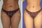 Liposuction 
