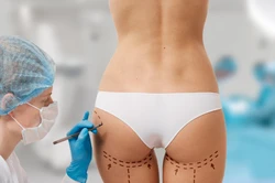 Buttocks Augmentation with Fat in Istanbul – Method, Results, and Cost 2025