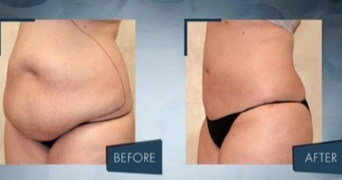 تجربة شد البطن 1 . الدكتور اولكر مناف باشي