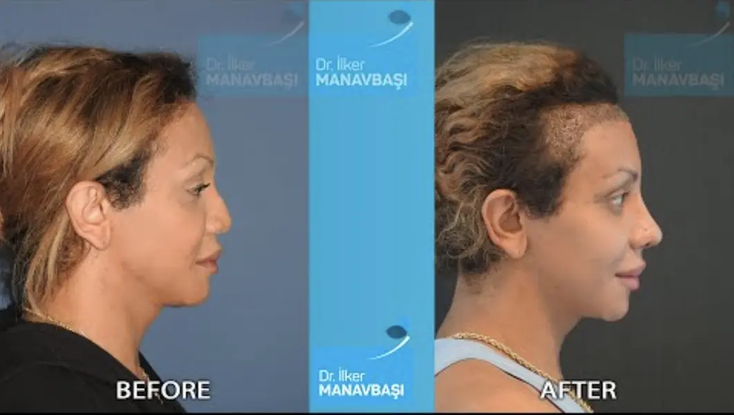 تجميل الانف في تركيا