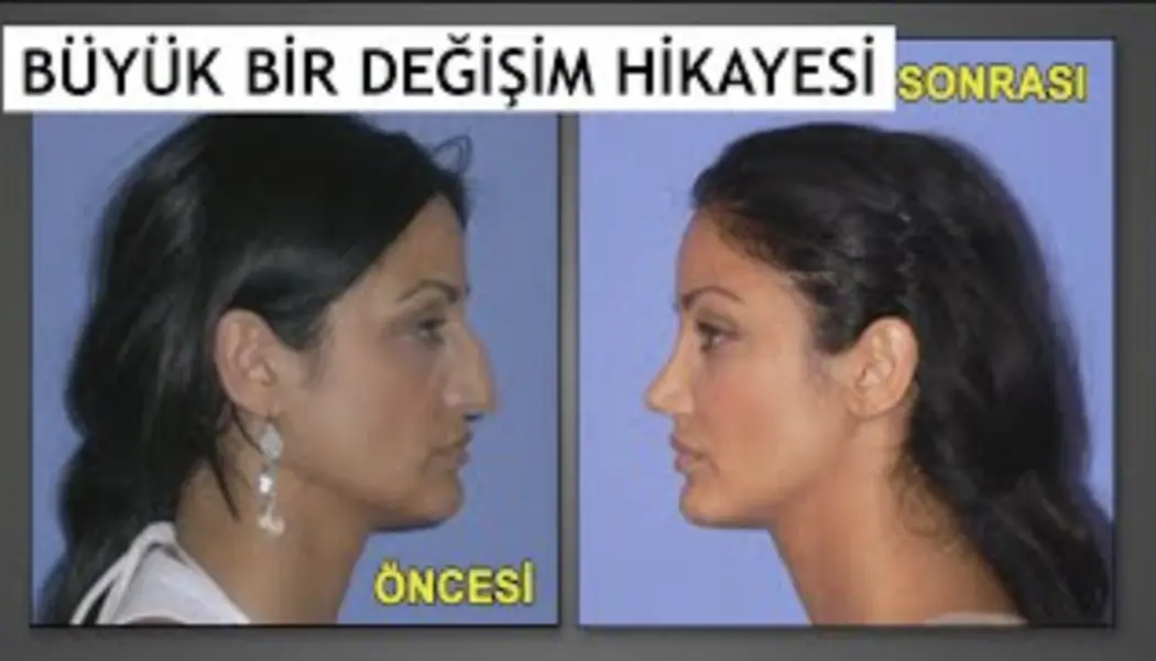 تجميل الانف في تركيا