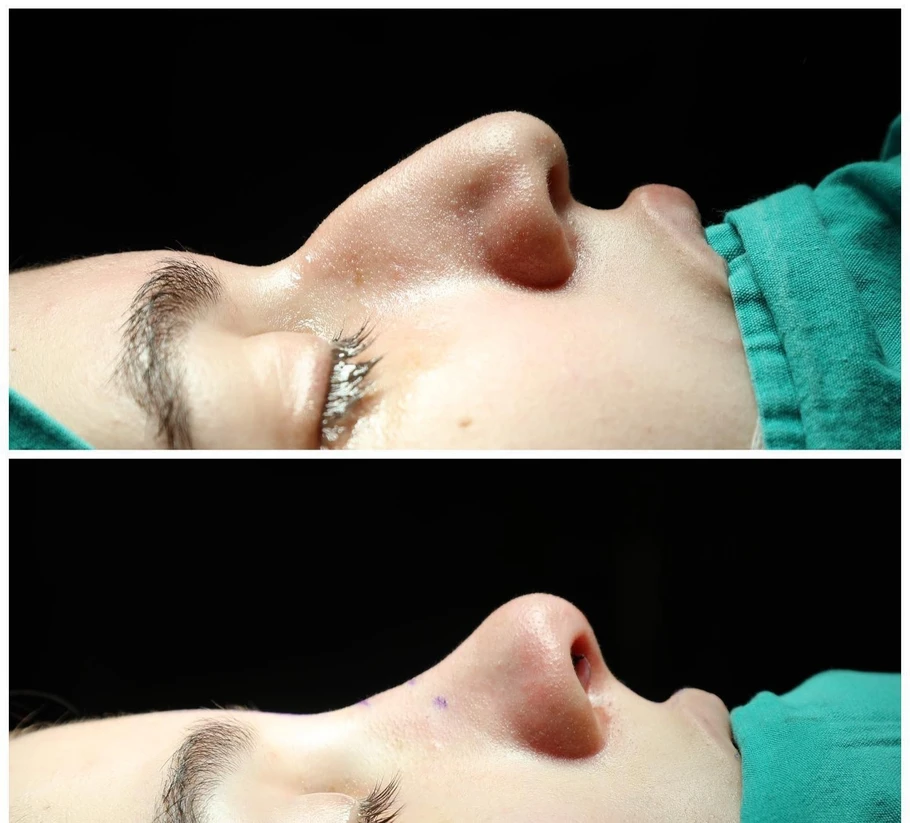 تجميل الانف في تركيا