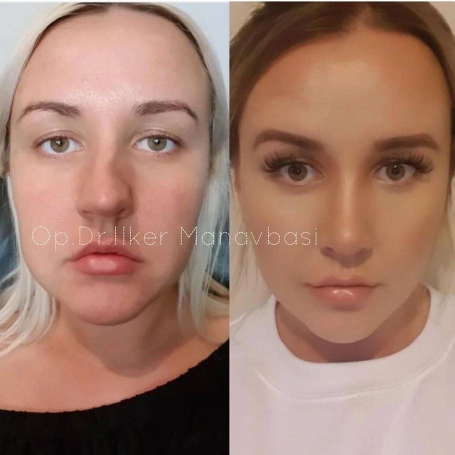 تجميل الانف في تركيا