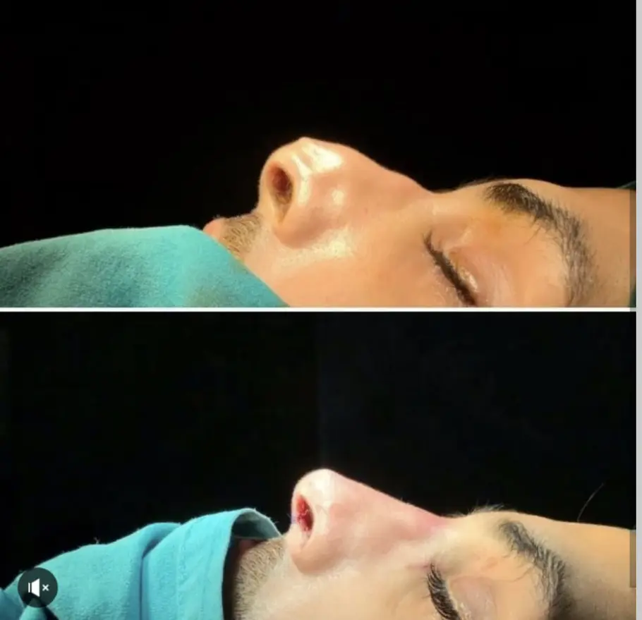 تجميل الانف في تركيا