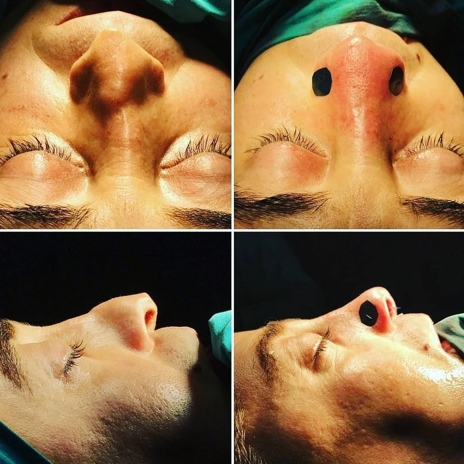 تجميل الانف في تركيا