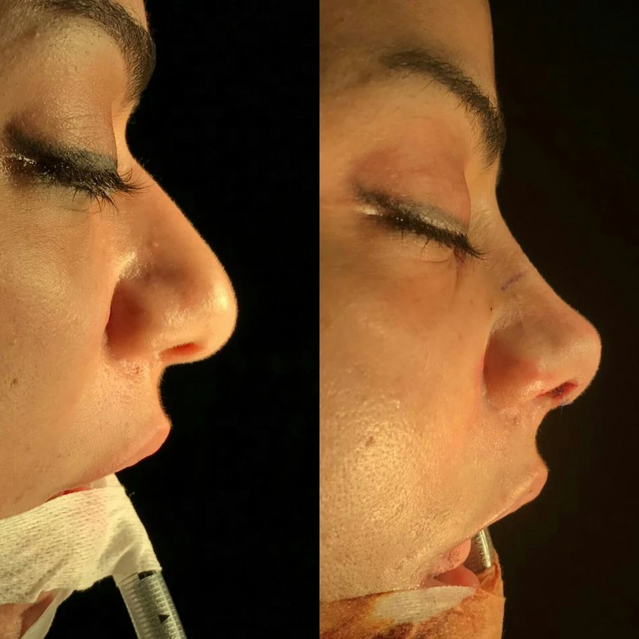 تجميل الانف في تركيا