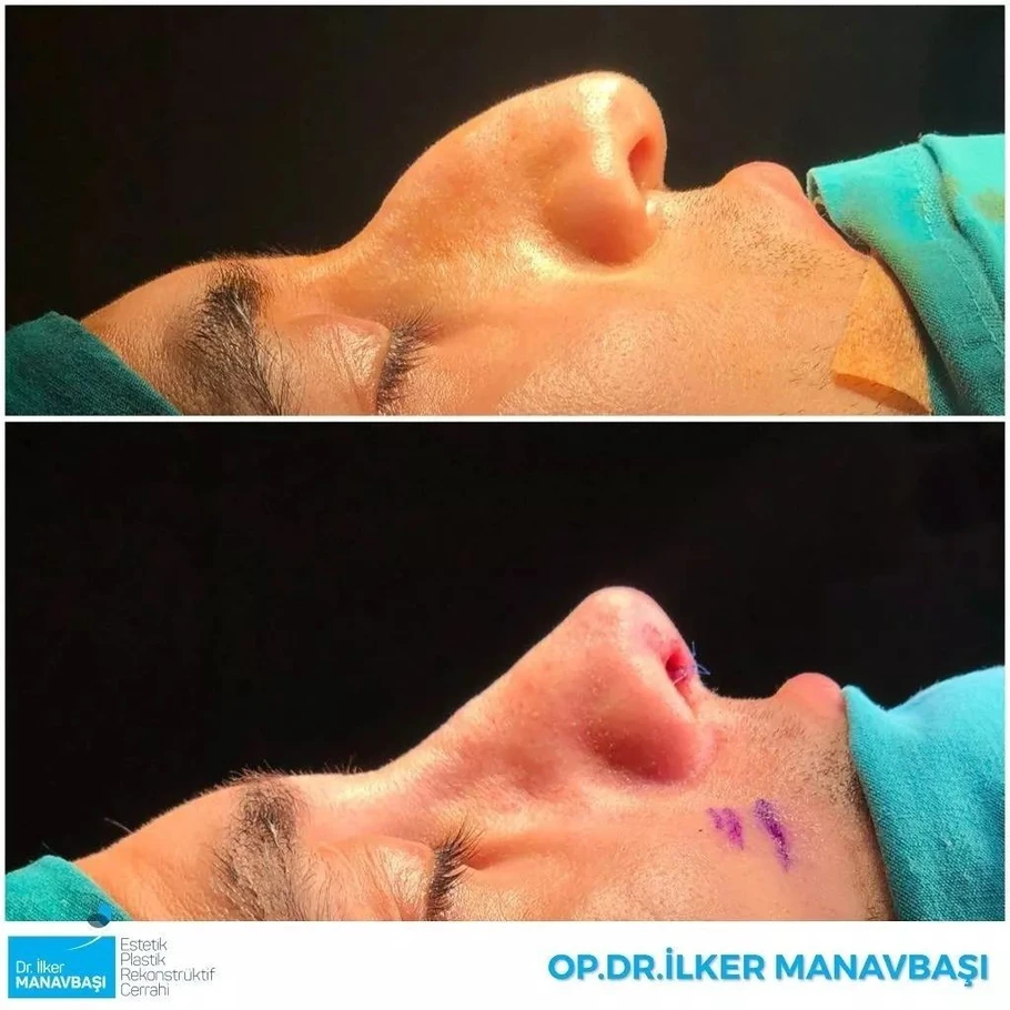 تجميل الانف في تركيا