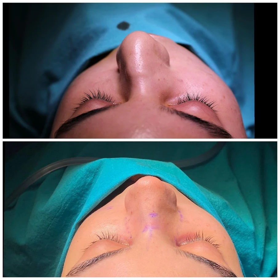 تجميل الانف في تركيا