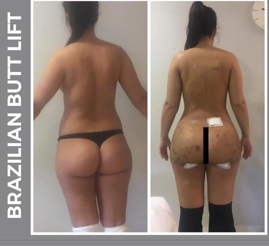 حقن الدهون في المؤخرة