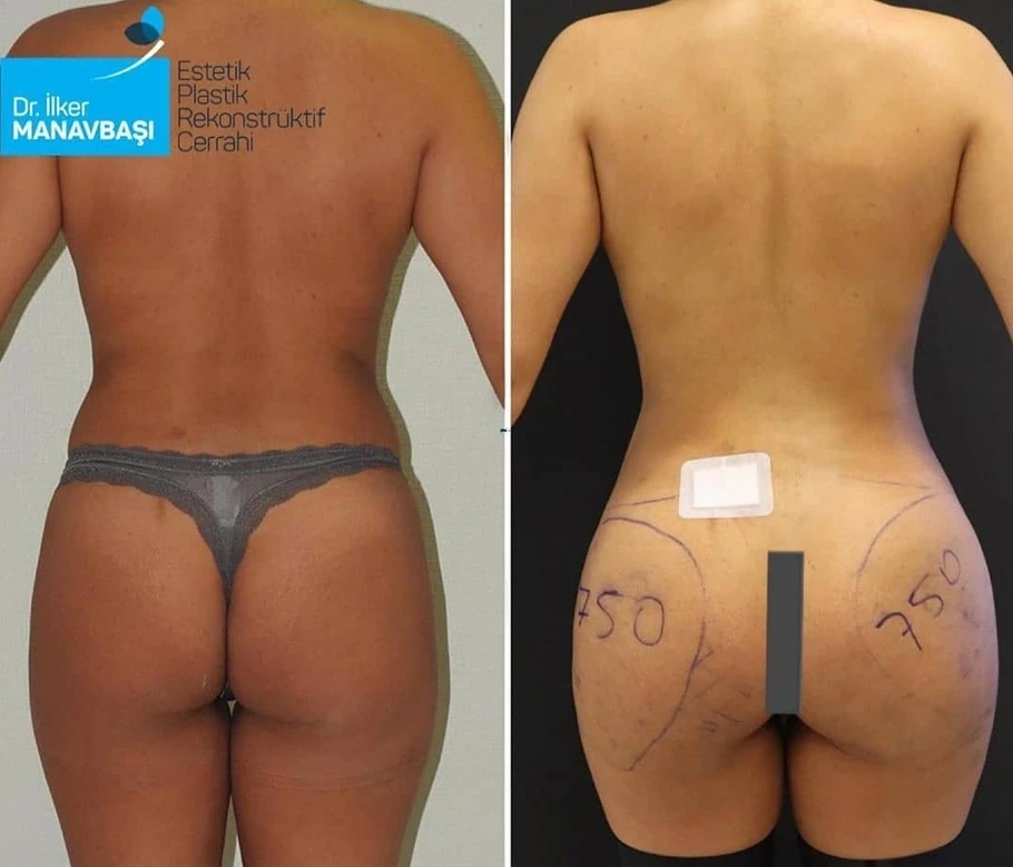 حقن الدهون في المؤخرة