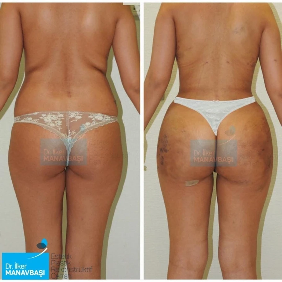 حقن الدهون في المؤخرة