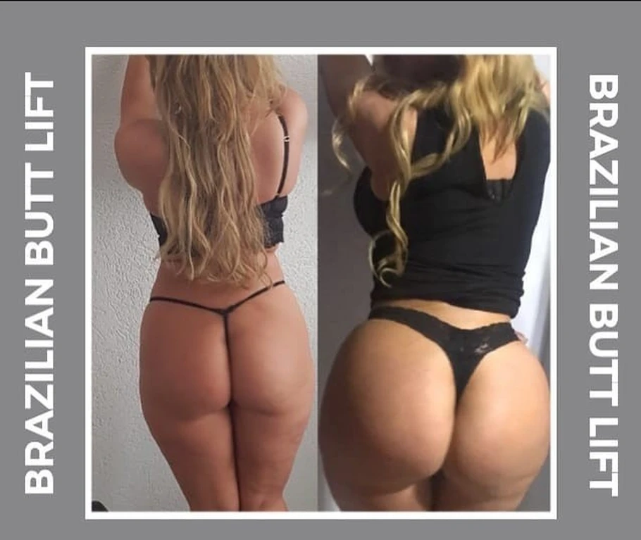 حقن الدهون في المؤخرة