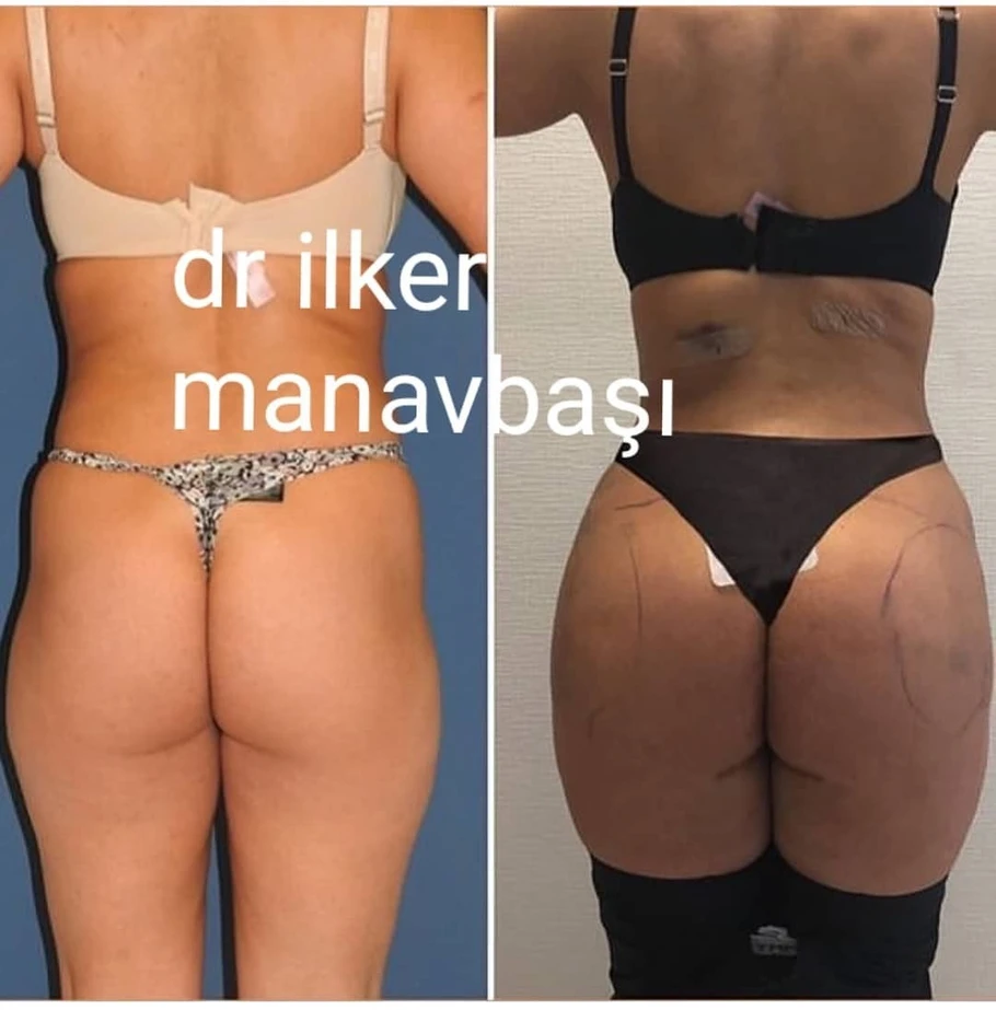 حقن الدهون في المؤخرة