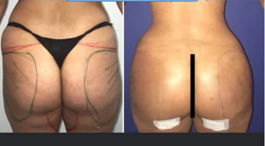 حقن الدهون في المؤخرة