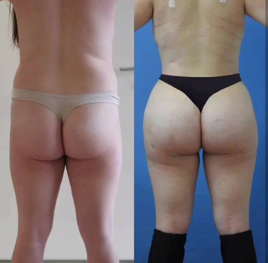 حقن الدهون في المؤخرة