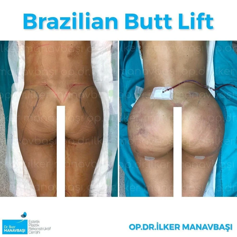 حقن الدهون في المؤخرة