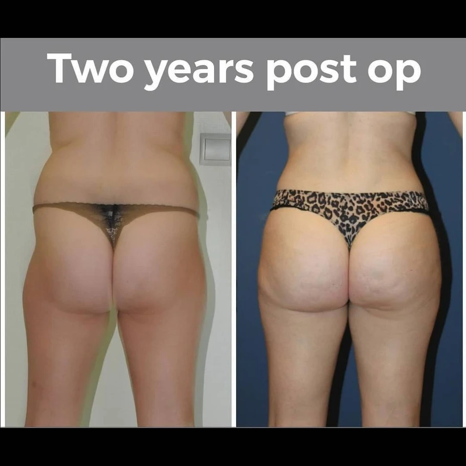 حقن الدهون في المؤخرة