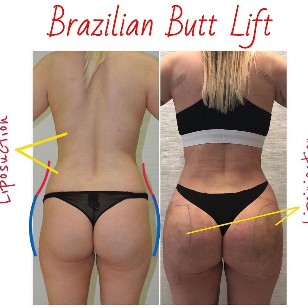 Brezilya popo büyütme BBL