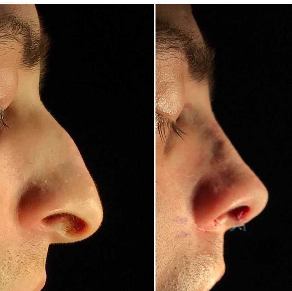 Burun estetiği ameliyatı